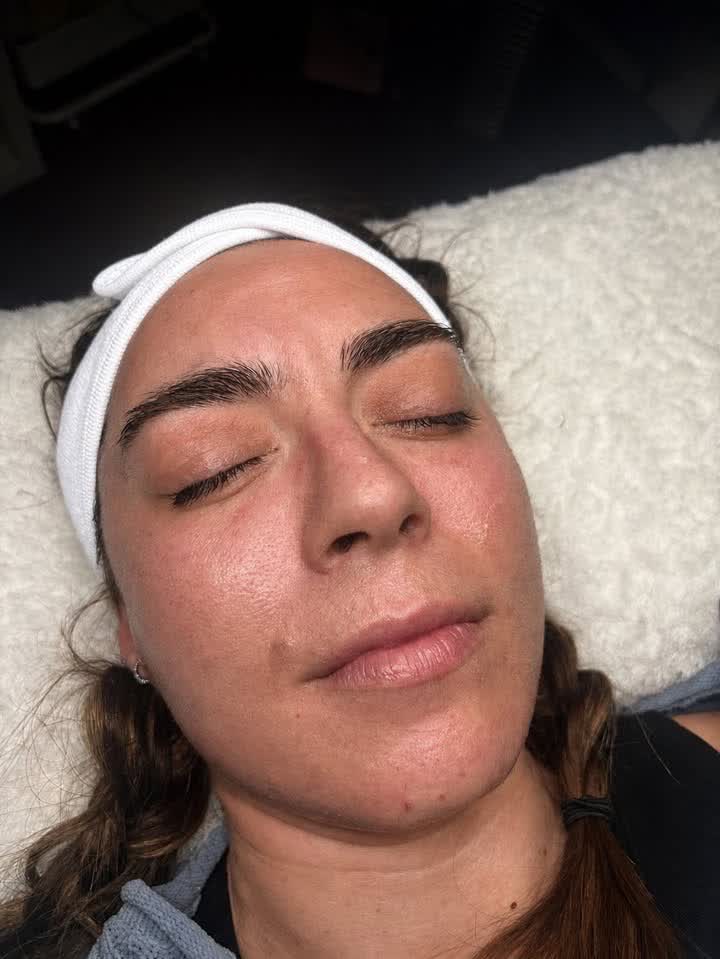 Client before microneedling and peel