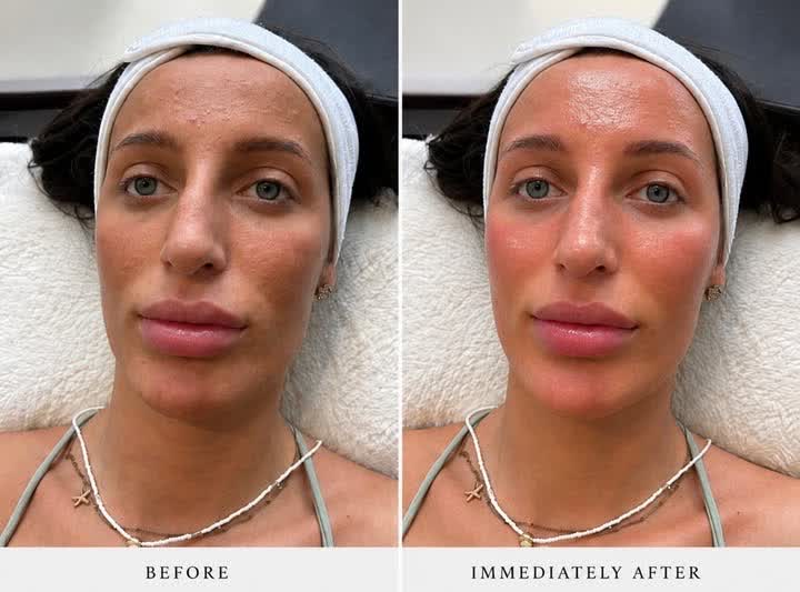 Client before and immediately after a facial at Stephanie's Beauty Lounge, Macclesfield